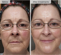 Refresh the look of dull skin with the Micro-Infusion Facial System